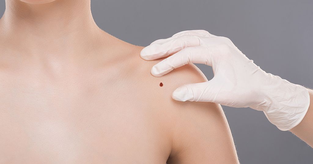 Dermatologist examining birthmark on woman shoulder, panorama